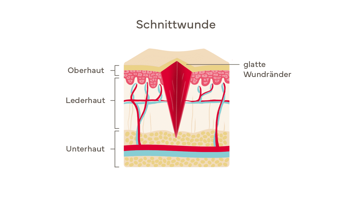 Warum Darf Eine Geklebte Wunde Nicht Nass Werden medical-wundmanagement.de
